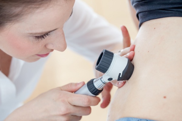 prevenzione melanoma