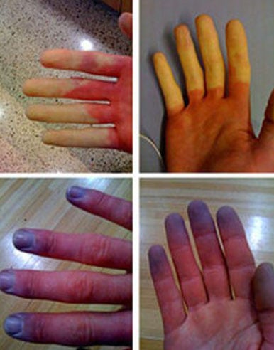 sindrome Raynaud